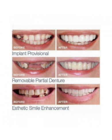 Prothèses dentaires supérieures inférieures - Snap On Fausses dents pour un sourire parfait