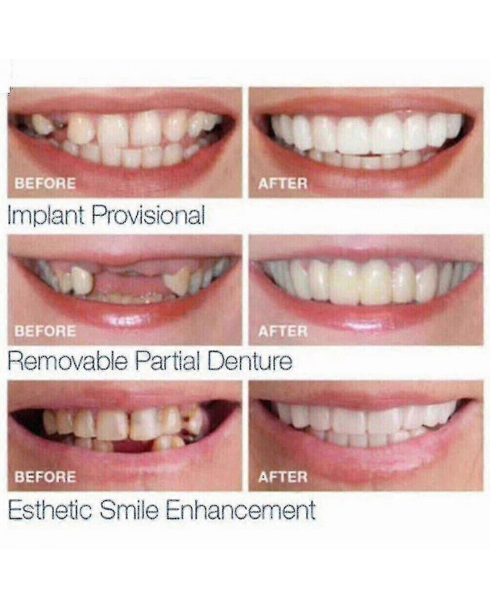 Prothèses dentaires supérieures inférieures - Snap On Fausses dents pour un sourire parfait