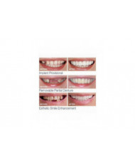 Prothèses dentaires supérieures inférieures - Snap On Fausses dents pour un sourire parfait