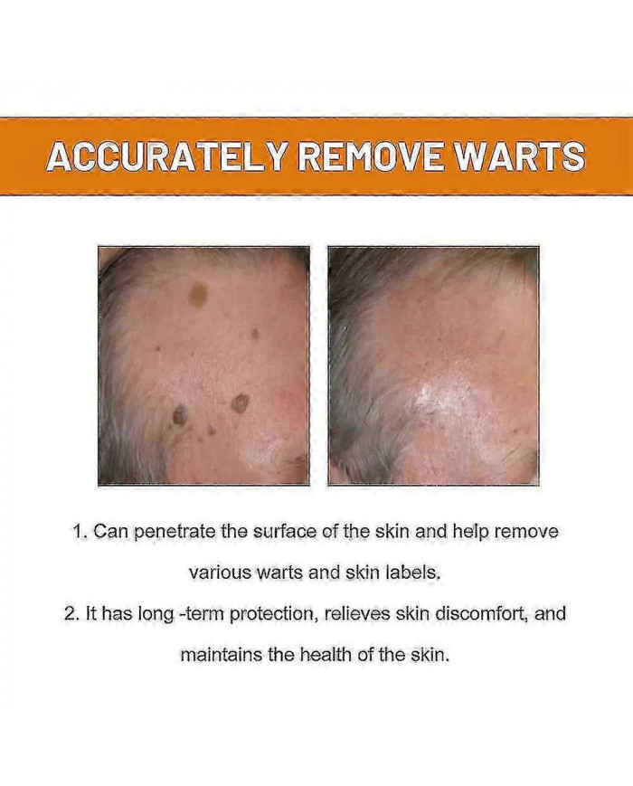 Venin d’abeille pour les verrues et les papillomes