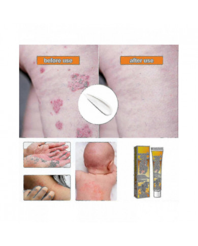 Gel de traitement au venin d’abeille à usage professionnel - 1-10pcsn