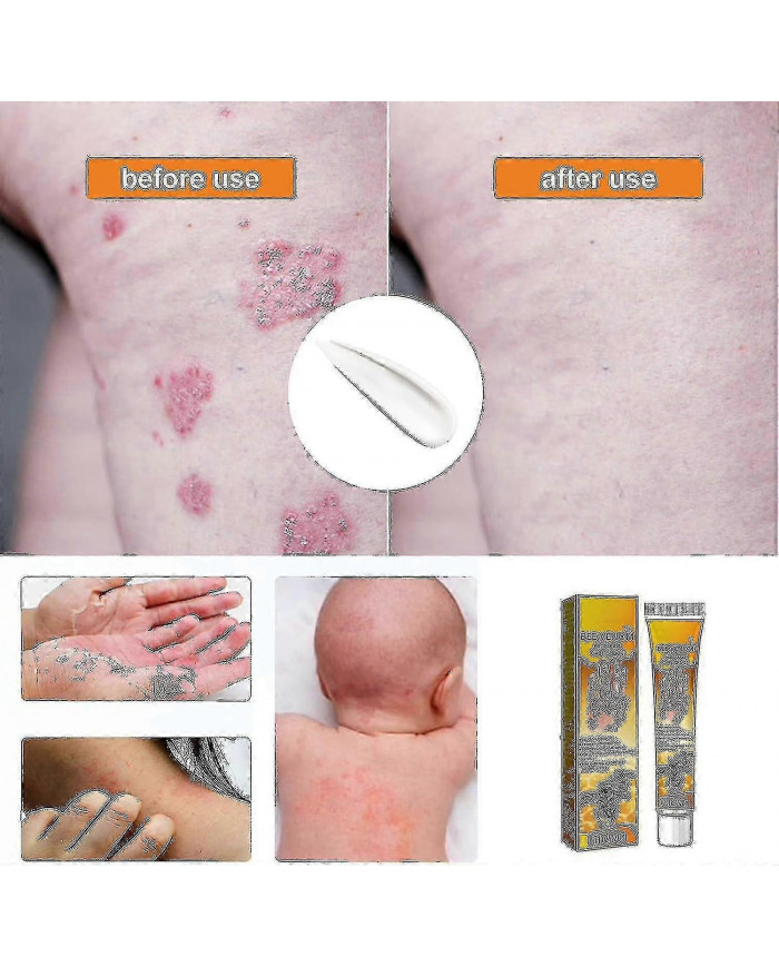 Gel de traitement au venin d’abeille à usage professionnel - 1-10pcsn