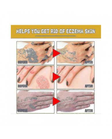 Gel de traitement au venin d’abeille à usage professionnel - 1-10pcsn