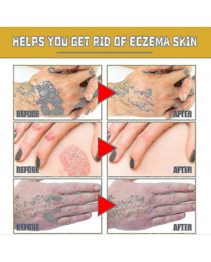 Gel de traitement au venin d’abeille à usage professionnel - 1-10pcsn