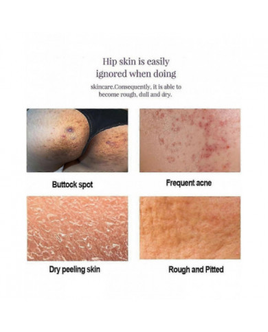 Crème anti-acné fessier, Crème hydratante lissante hanches, Crème éclaircissante fesses et cuisses, Crème [...]