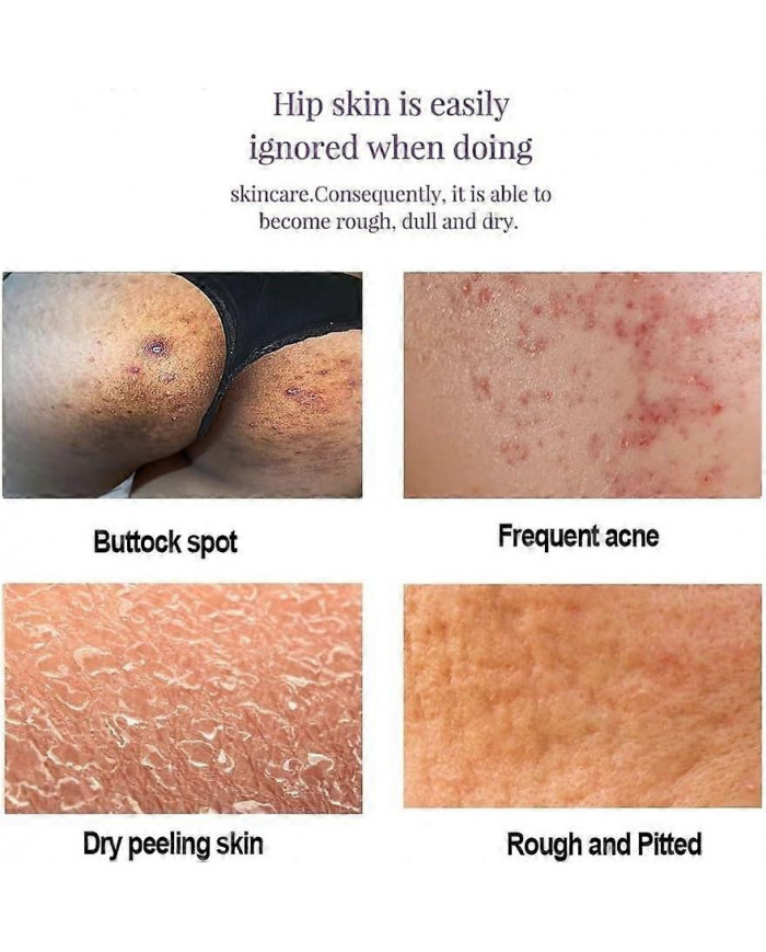 Crème anti-acné fessier, Crème hydratante lissante hanches, Crème éclaircissante fesses et cuisses, Crème [...]