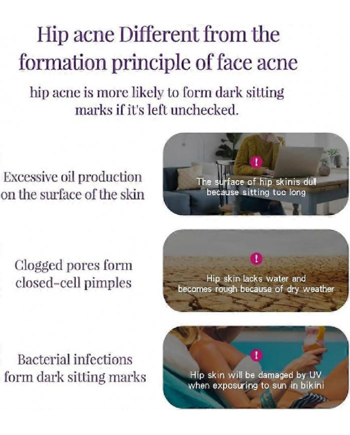 Crème anti-acné fessier, Crème hydratante lissante hanches, Crème éclaircissante fesses et cuisses, Crème [...]