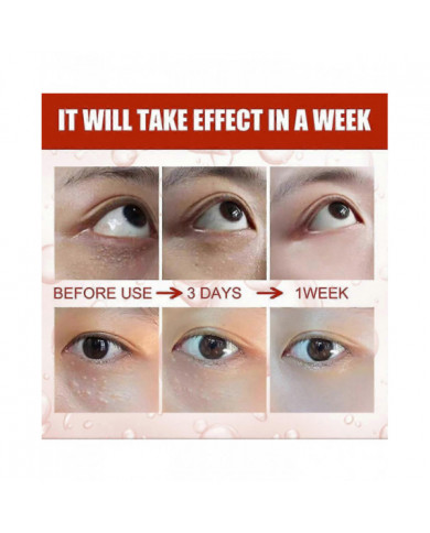 Milia Remover Sérum Essentiel pour les Yeux Efficace Élimine les granules de graisse Poches sous les yeux Anti- [...]