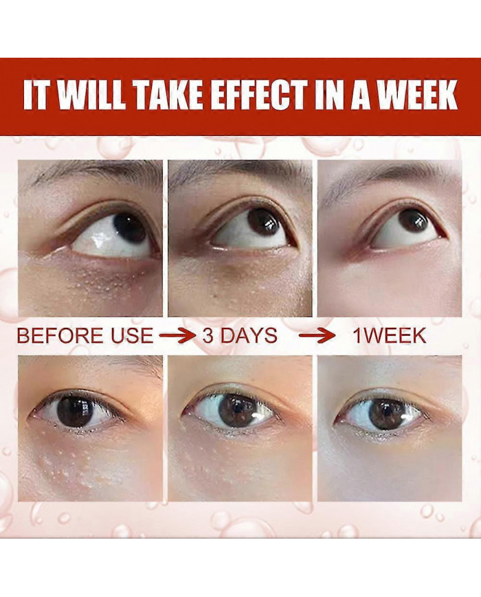 Milia Remover Sérum Essentiel pour les Yeux Efficace Élimine les granules de graisse Poches sous les yeux Anti- [...]