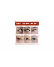 Milia Remover Sérum Essentiel pour les Yeux Efficace Élimine les granules de graisse Poches sous les yeux Anti- [...]