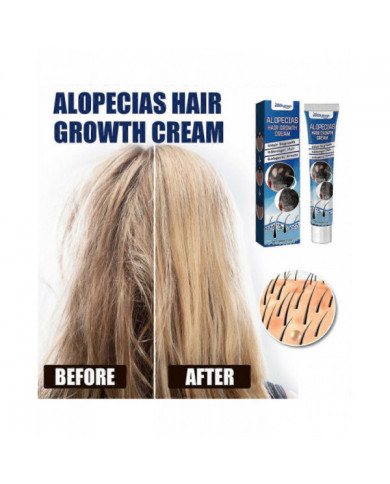 1-3X Nouvelle Crème de Traitement de l’Alopécie Croissance des Cheveux Prévenir L’Alopécie Caldness Repousse 20g