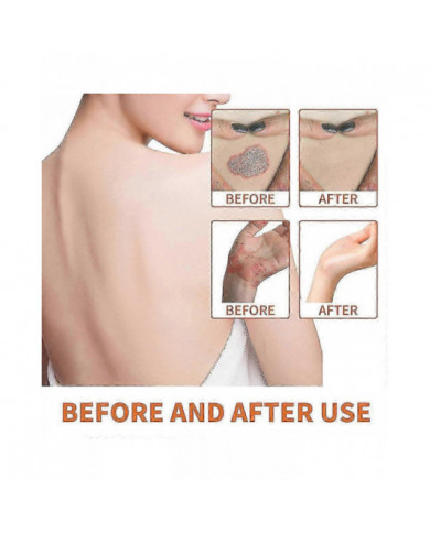 3/5pcs Psoriasises Crème, Sérum d’abeille Psoriasises Crème Soulagement de la peau Crème anti-démangeaisons [...]