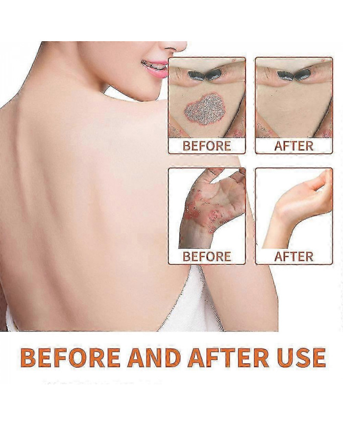 3/5pcs Psoriasises Crème, Sérum d’abeille Psoriasises Crème Soulagement de la peau Crème anti-démangeaisons [...]