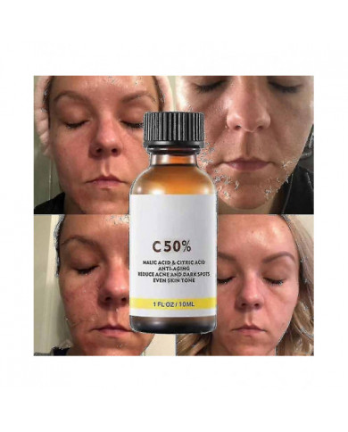 50% Peel Chimique Tca Peel Acide Peau Superforce Peel Pigmentation Éclaircissement Mélanine Traitement de l’acné [...]