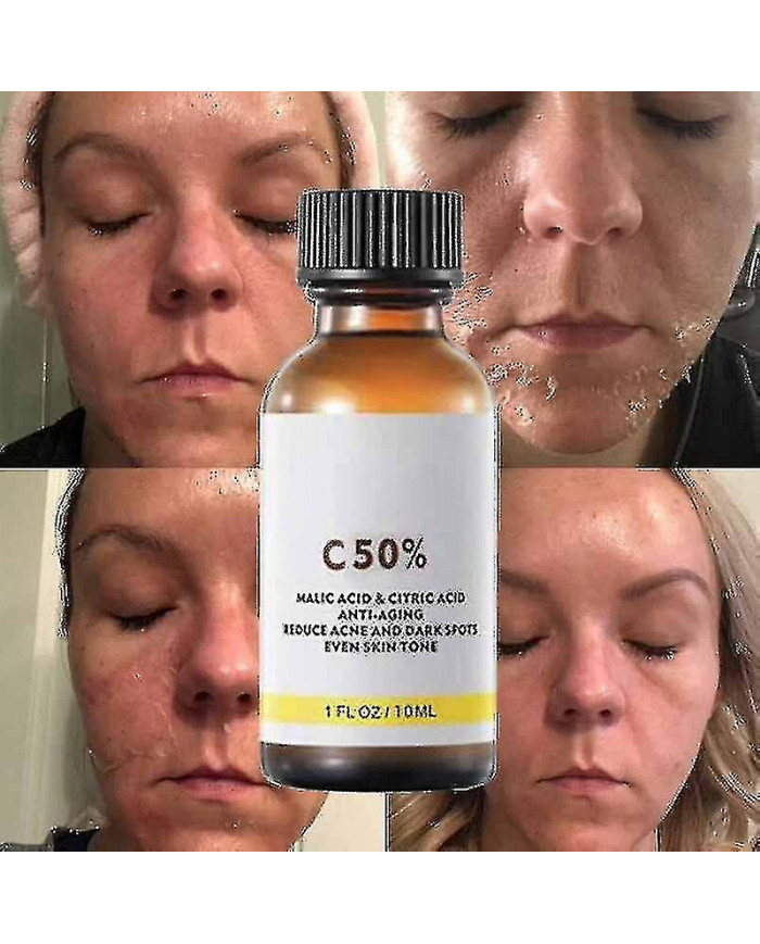 50% Peel Chimique Tca Peel Acide Peau Superforce Peel Pigmentation Éclaircissement Mélanine Traitement de l’acné [...]