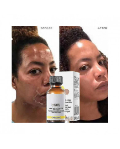 50% Peel Chimique Tca Peel Acide Peau Superforce Peel Pigmentation Éclaircissement Mélanine Traitement de l’acné [...]