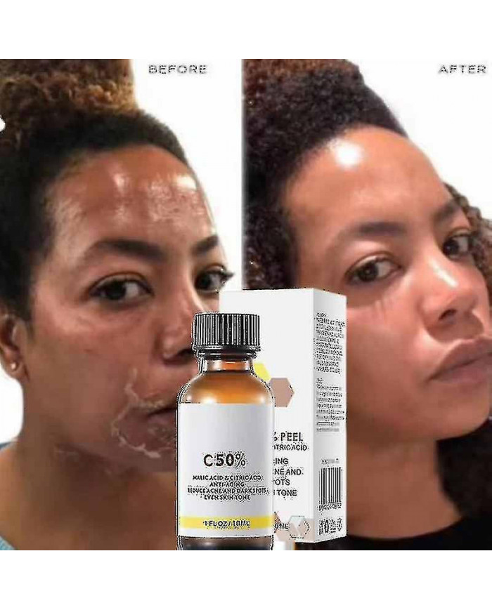 50% Peel Chimique Tca Peel Acide Peau Superforce Peel Pigmentation Éclaircissement Mélanine Traitement de l’acné [...]
