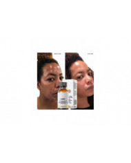 50% Peel Chimique Tca Peel Acide Peau Superforce Peel Pigmentation Éclaircissement Mélanine Traitement de l’acné [...]