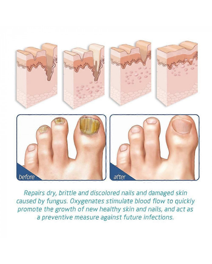 1-10xOnycostop Pro Pied et Ongle Spary Pied Traitement des odeurs Spray Sérum de croissance des ongles
