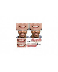 Extra Thin Fake Bright White Tooth Faceers Silicone Soft Safe Adhesive Denture Hide Hide Shade Braces Comfortable [...]